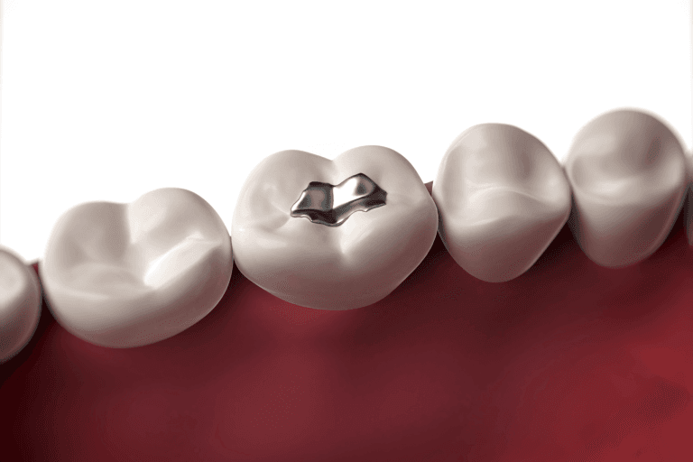 Amalgamska plomba ili tzv. siva tj. crna plomba