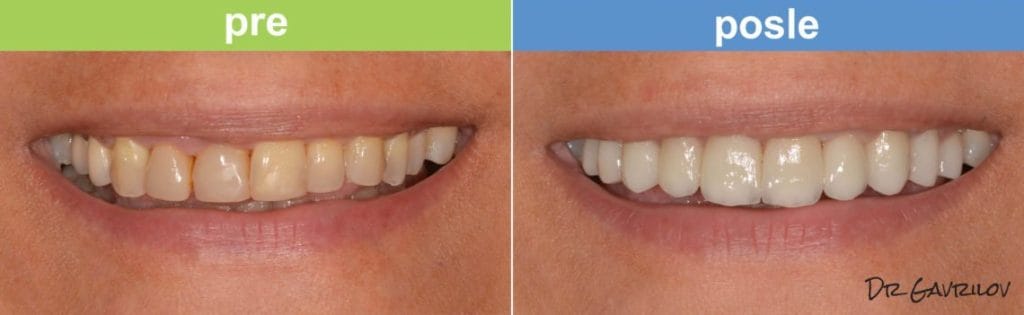 Rezultati ugradnje bezmetalnih keramičkih krunica.