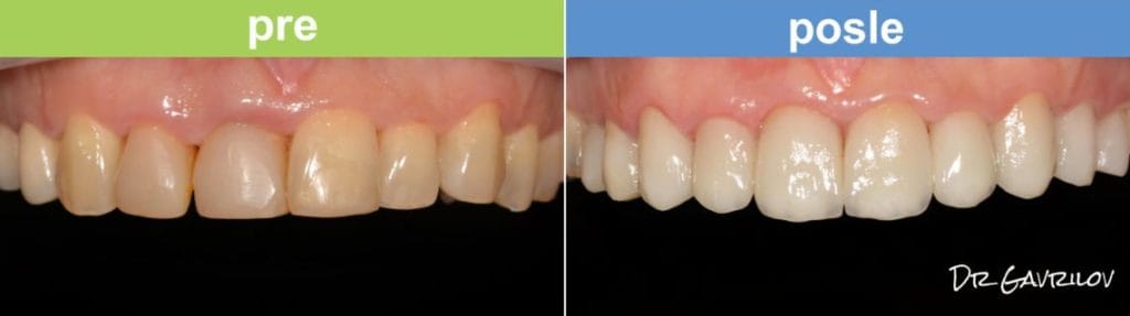 Bezmetalne keramičke krunice - pravi izbor za ulepšavanje osmeha.