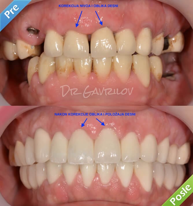Laserski tretman desni sa očiglednim rezultatima!