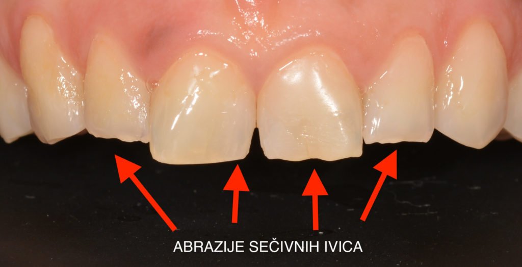 Oštećenja sečivnih ivica zuba nastaju kao posledica bruksizma.