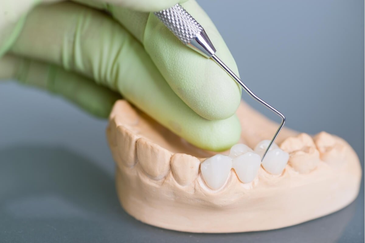 Zubne krunice sa garancijom kvaliteta