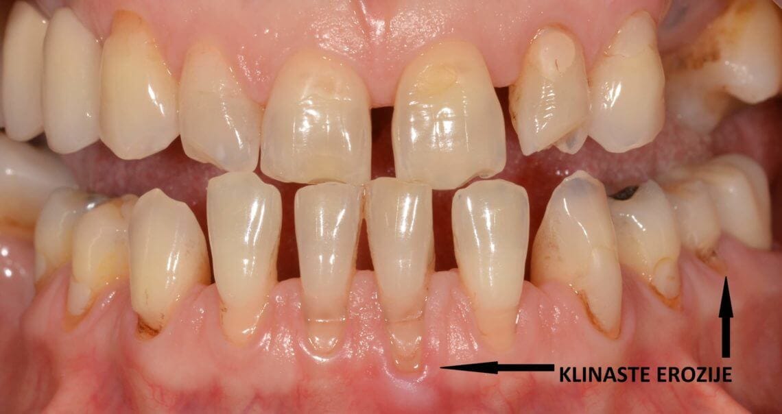 Magic Dent - Klinaste erozije zuba