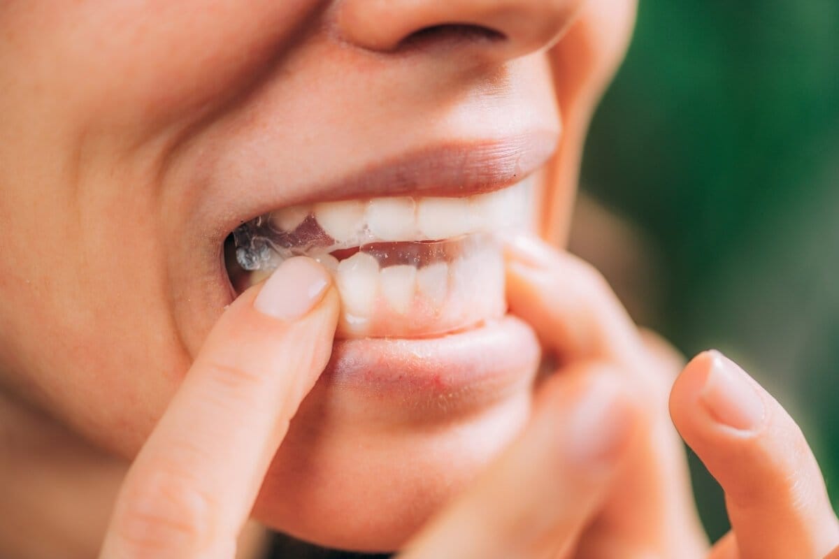 Da li trakice za izbeljivanje zuba mogu postići željene rezultate?