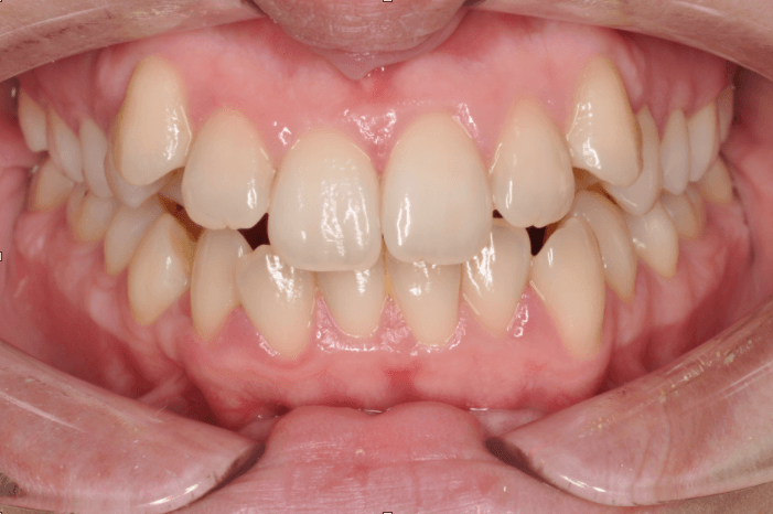 Zubi pre nošenja fiksne proteze
