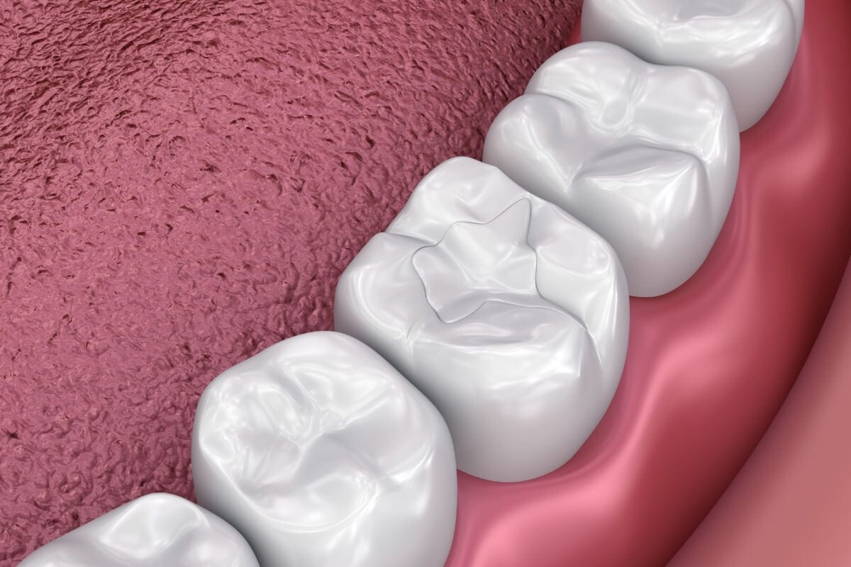 Popravka zuba je proces koji se završava plombiranjem zuba.