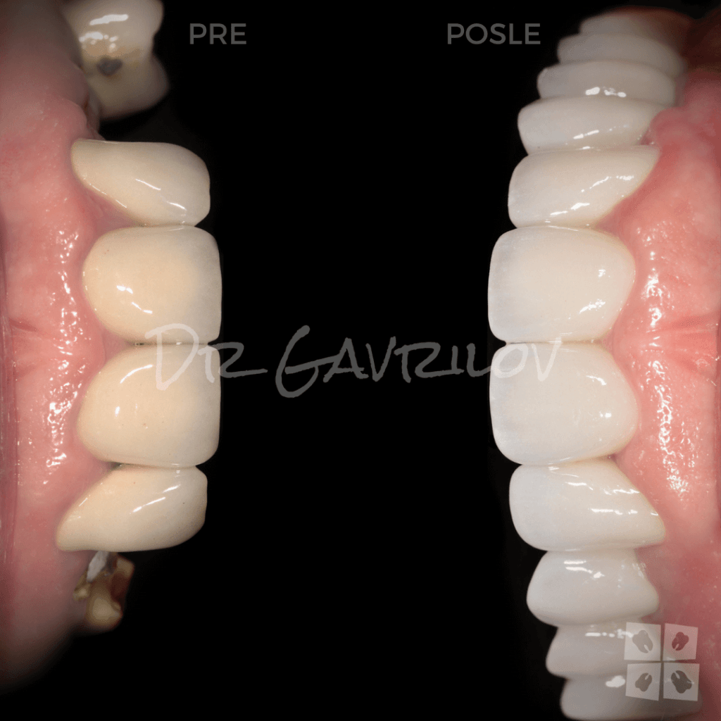 Navlake za zube: slike radova su najbolji pokazatelj odličnih rezultata
