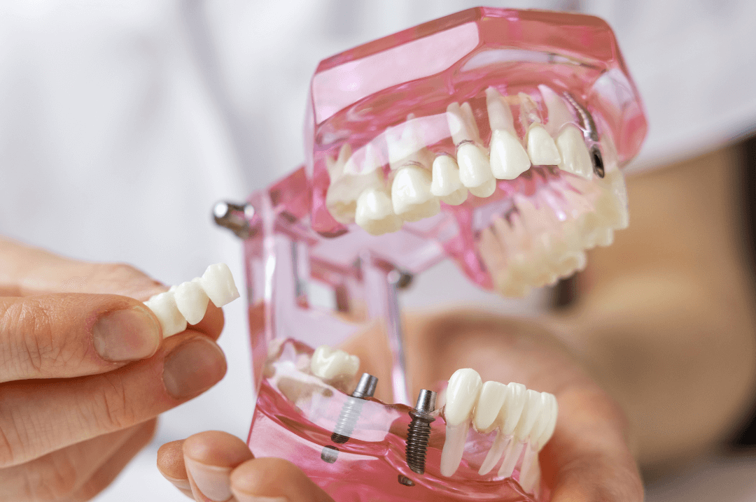 Trajnost zubnih implantata zavisi od više faktora