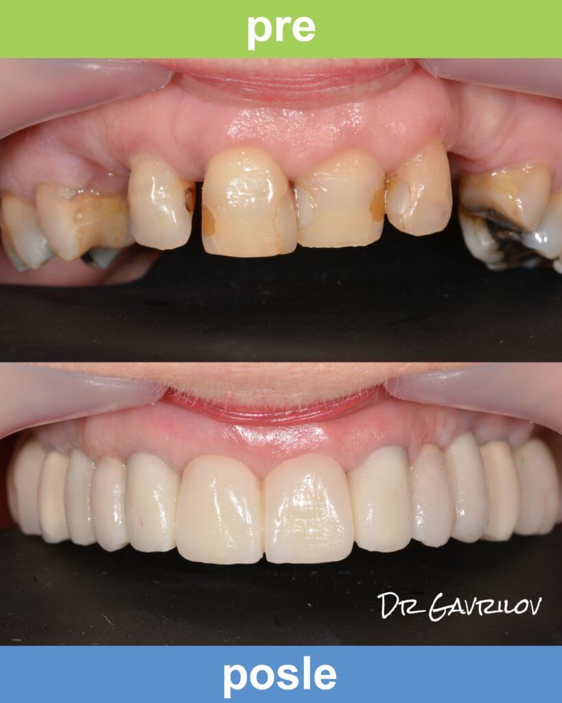 Protetika zuba: radovi Magic Dent stomatologa