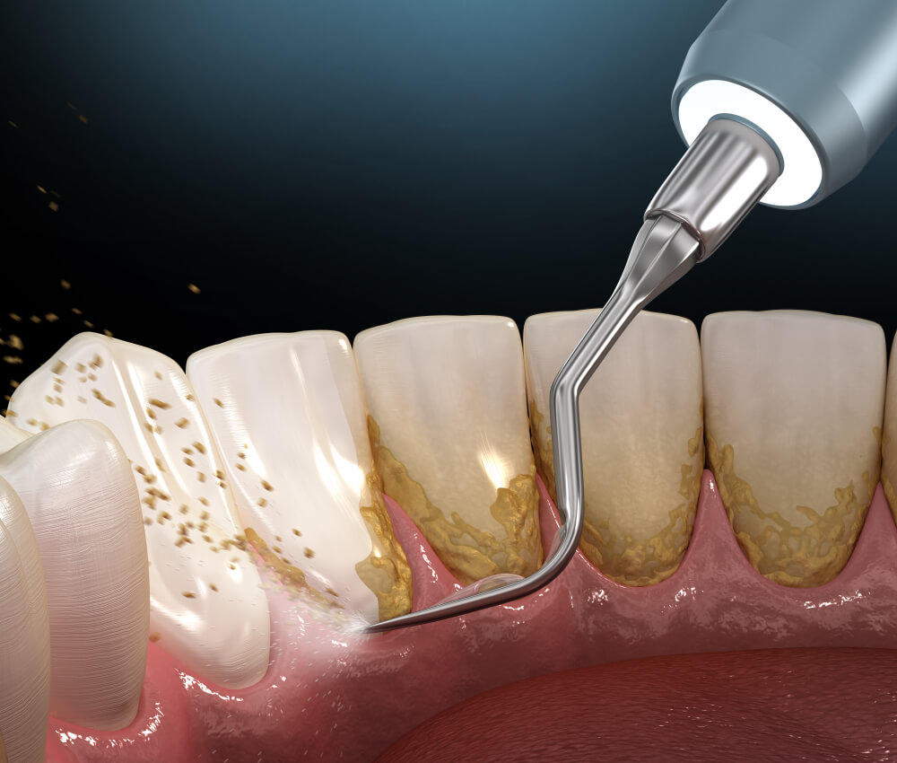 Saveti stomatologa: kako skinuti kamenac sa zuba