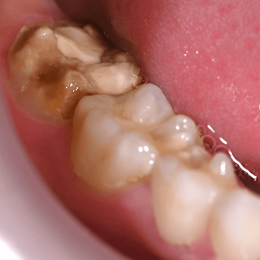 MIH zuba, donja desna sedmica