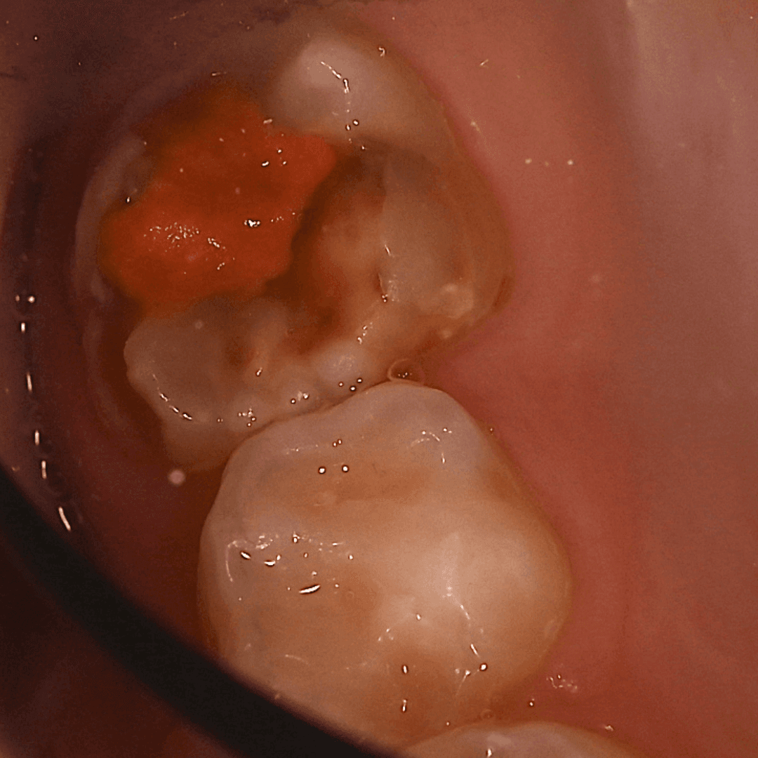 MIH - Gornja desna šestica, zub 16