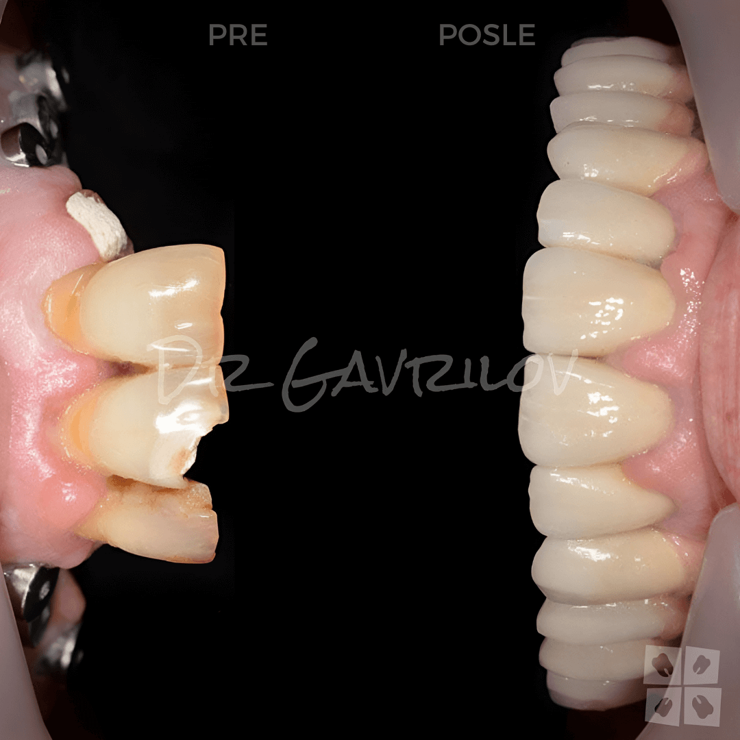 Najbolji implanti u Beogradu za savršen osmeh - Pre i posle