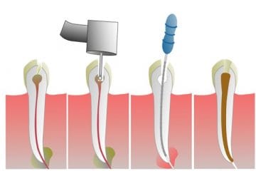 Endodoncija: ručni i mašinski instrumenti