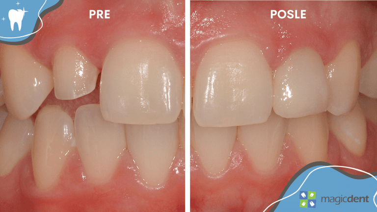 Luminiri (non prep viniri): pre i posle