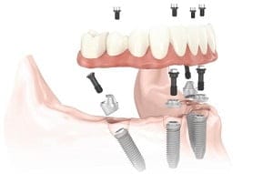 Magic Dent - Implantologija obuhvata i izradu mobilnih proteza na implantatima.