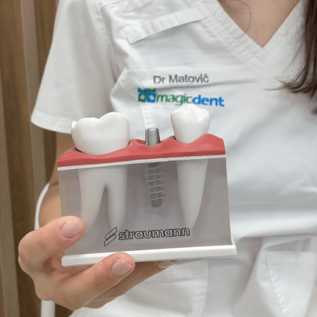 Prednosti zubnih implantata i moguće komplikacije